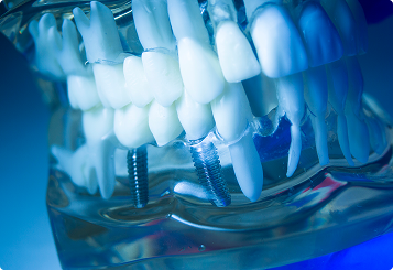 implant_image01
