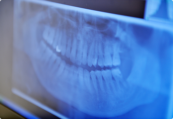 periodontal_image01
