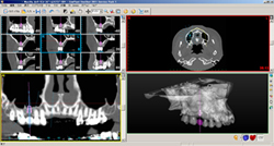 implant_image03