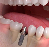 implant_image06