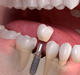 implant_image07